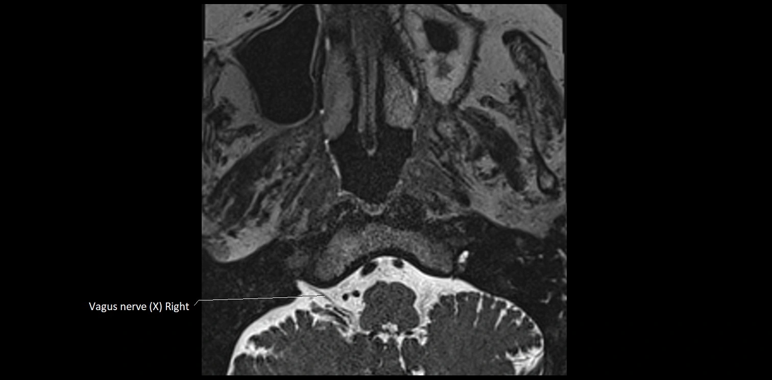 Cranial nerve anatomy axial MRI 3T image 73.webp